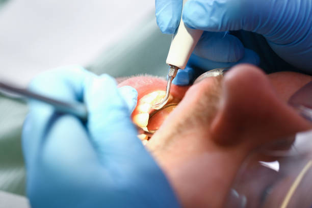 Best Emergency Treatment for Toothache in Cartersville, GA